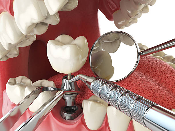 Best Emergency Root Canal Treatment in West Orange, TX